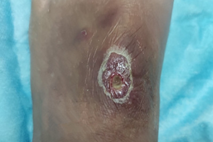 痈脚背小坑图 痈脚背小坑图