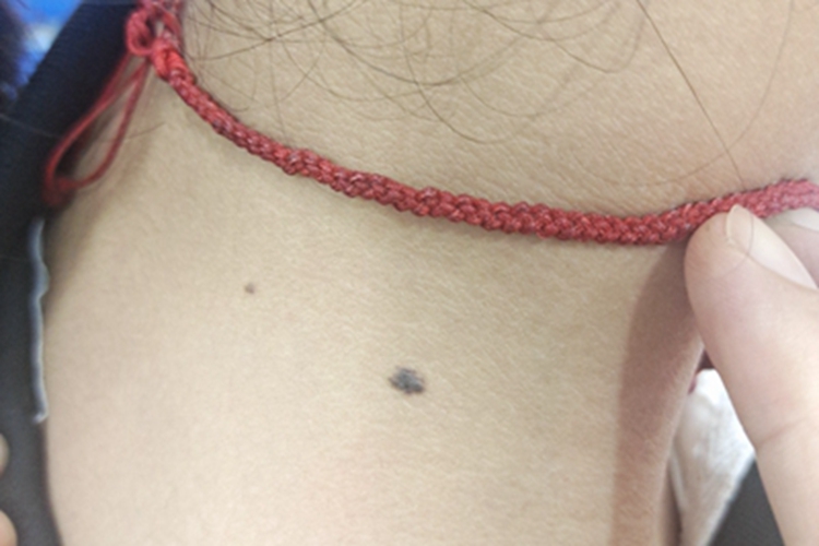 黑素细胞痣侧颈痣图