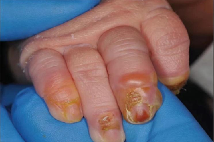 脓疱病手指水疱图