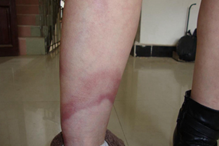 未定类型麻风小腿症状图