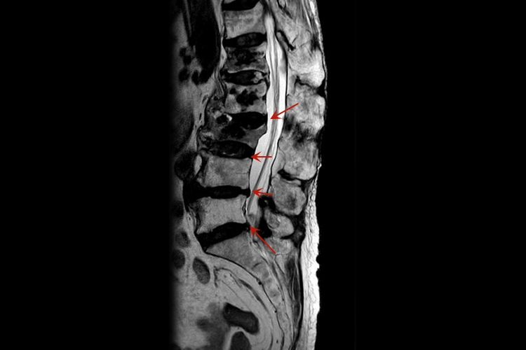 腰椎L3S1椎间盘膨出影像图