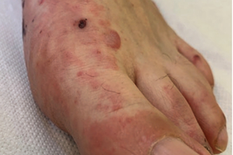 小螺菌型鼠咬热脚背症状图