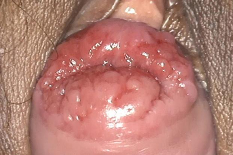 子宫脱垂局部溃疡