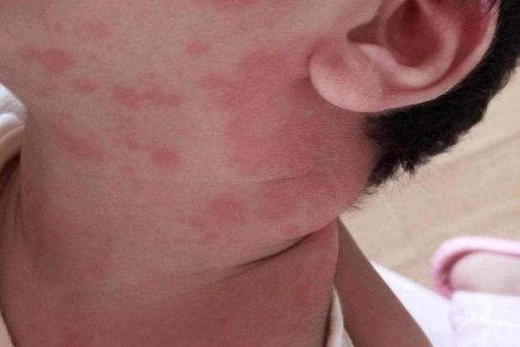 孩子过敏皮肤红斑图