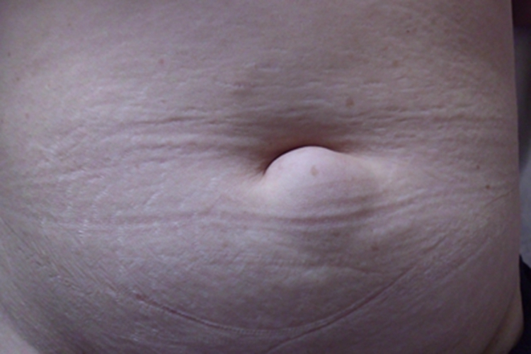 Ⅱ型痛性肥胖病症状图