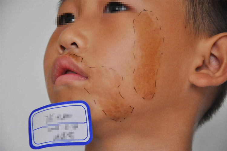 下巴长咖啡斑图