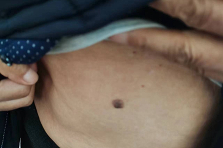 交界痣大疙瘩图 交界痣大疙瘩图