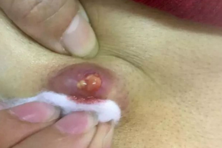 痈腹部症状图 痈腹部症状图