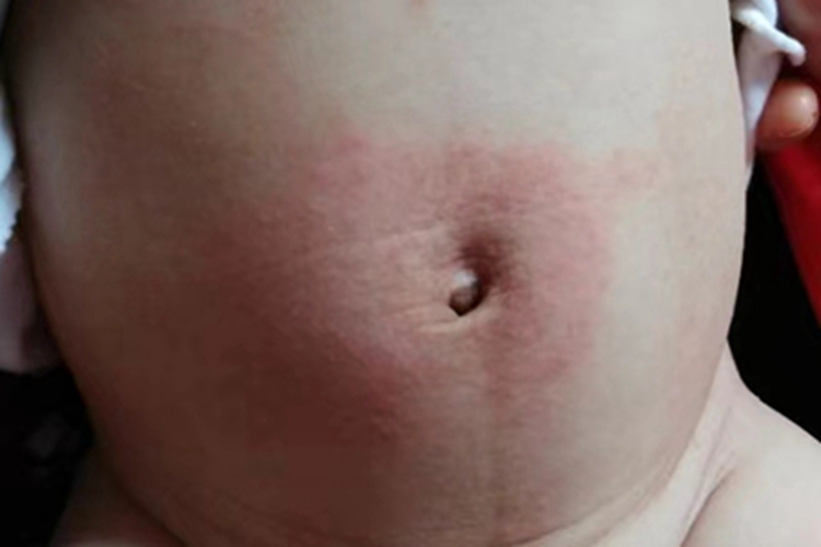 亚急性接触性皮炎肚脐红斑图