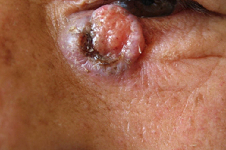 皮肤基底细胞癌眼周症状图