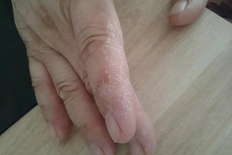 手部湿疹手指脱皮图