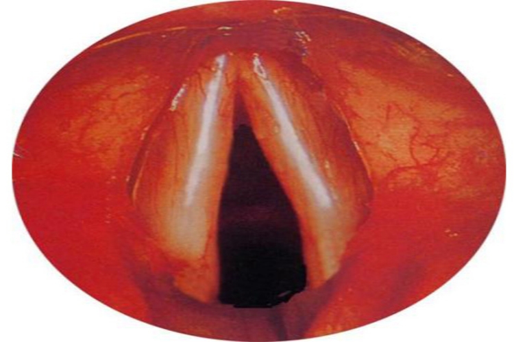 分泌物附着于声带表面图