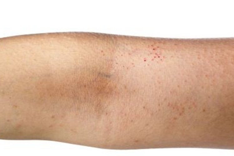 持久隆起性红斑胳膊有小红点图