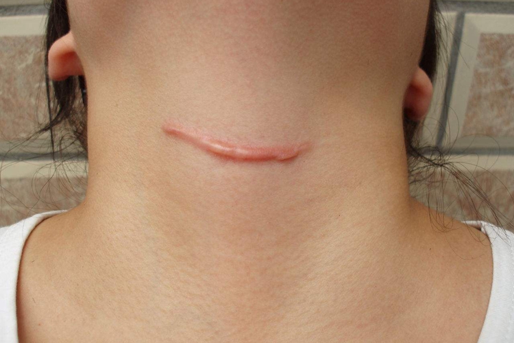 颈部手术瘢痕图 颈部手术瘢痕图