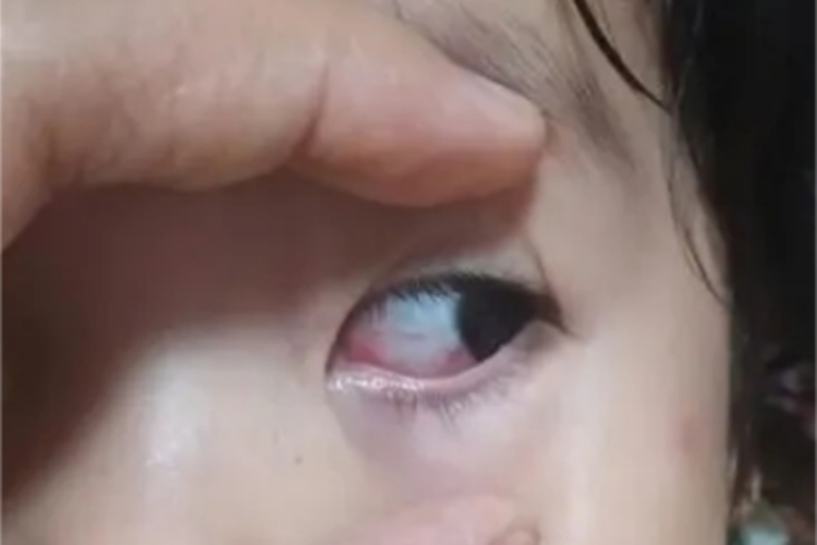 酪氨酸血症Ⅱ型结膜血丝图