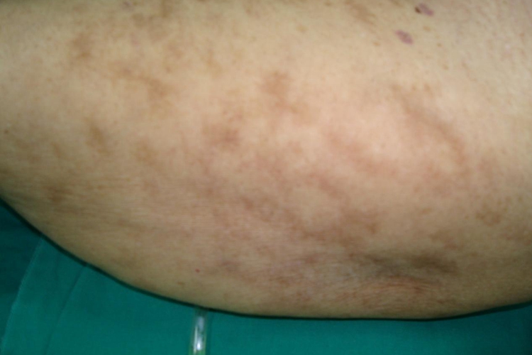 带状疱疹局部色素沉着图