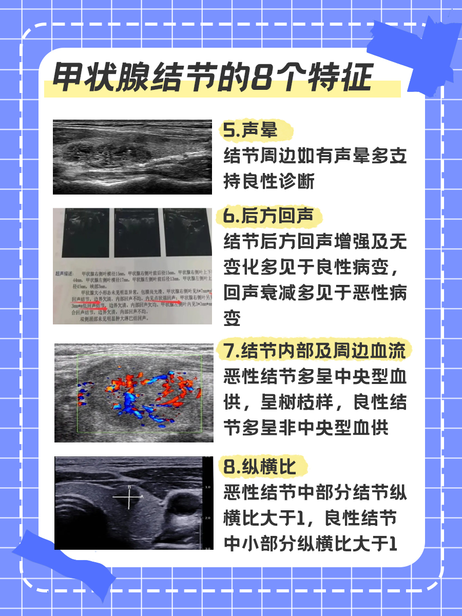 带你了解：甲状腺结节的8个特征，真嘟假嘟？