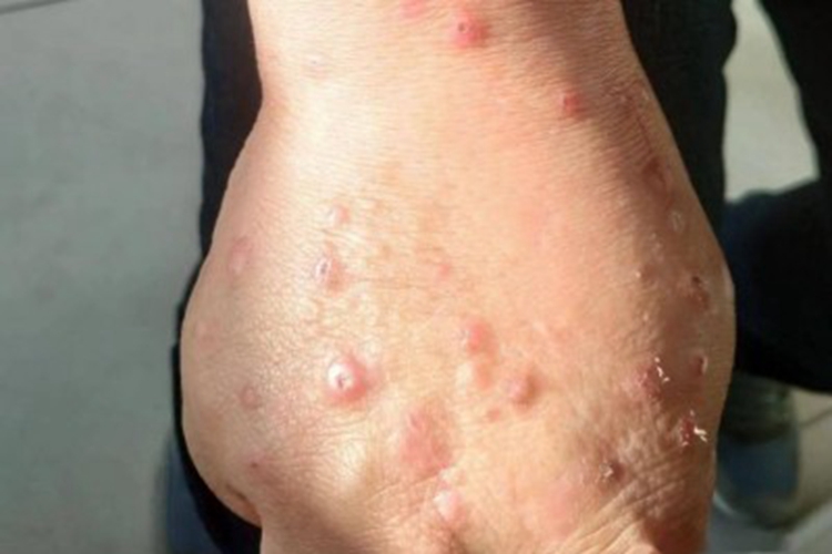 光化性痒疹手部脱皮图