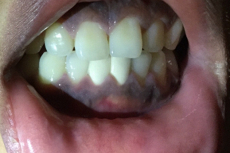 外源性色素沉着异常牙龈黑斑图