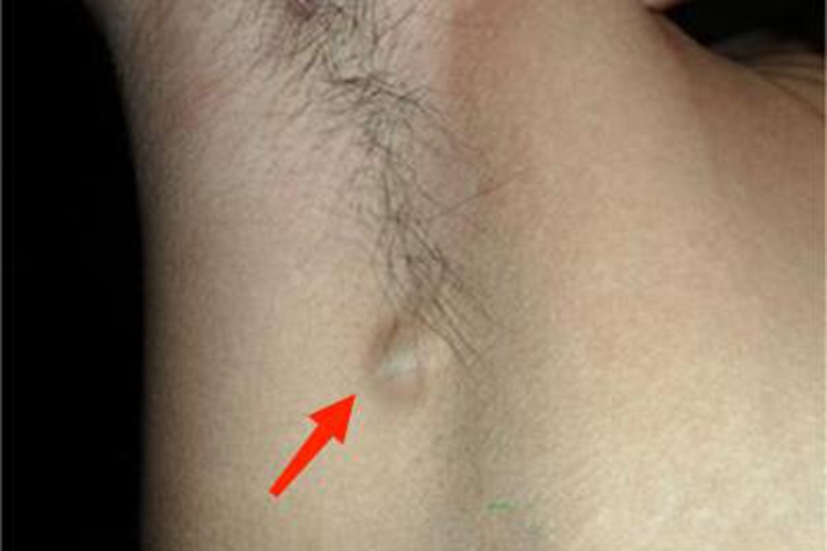 女性乳头状汗腺腺瘤腋窝症状图 女性乳头状汗腺腺瘤腋窝症状图