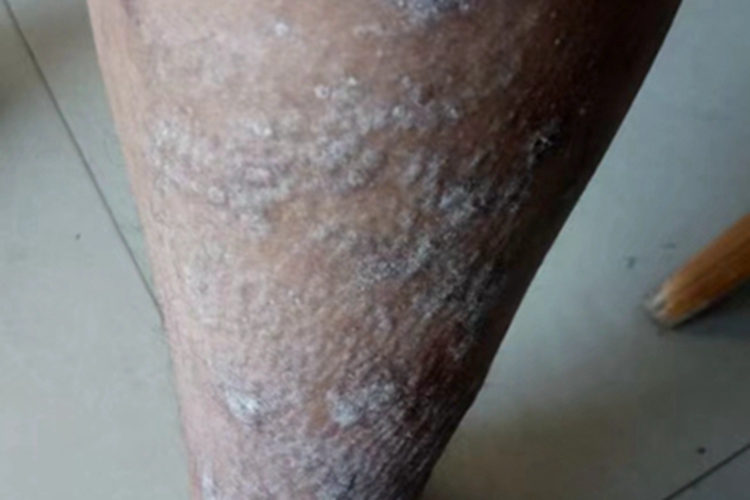 慢性湿疹小腿结灰白色痂块图