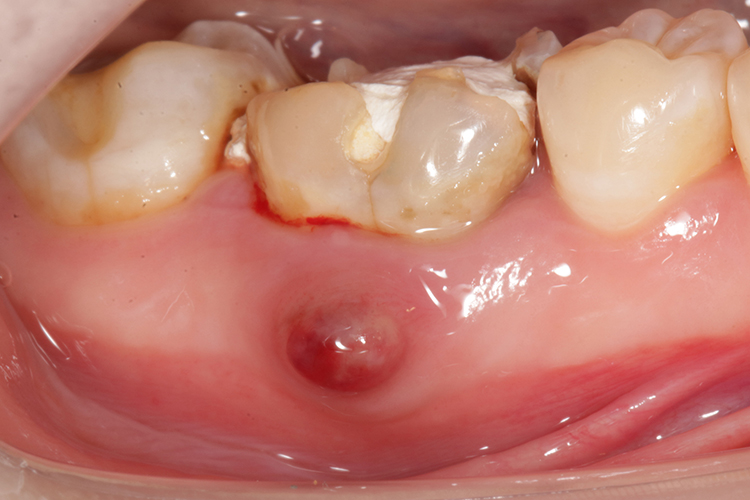 颊侧牙龈表面牙龈瘘管图
