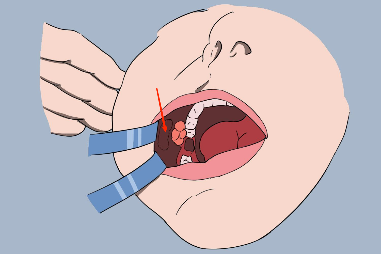 宝宝嘴两侧脂肪垫图