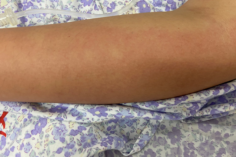 日光性荨麻疹风团图