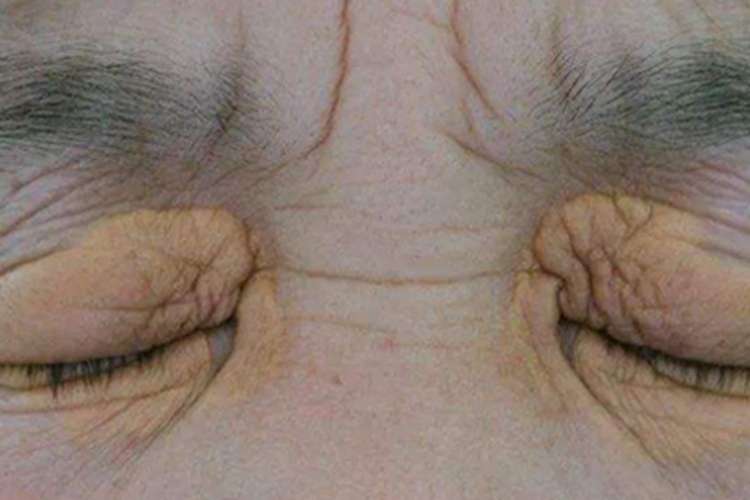 扁平黄瘤眼睑皮肤发黄图