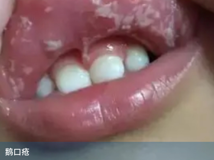 鹅口疮