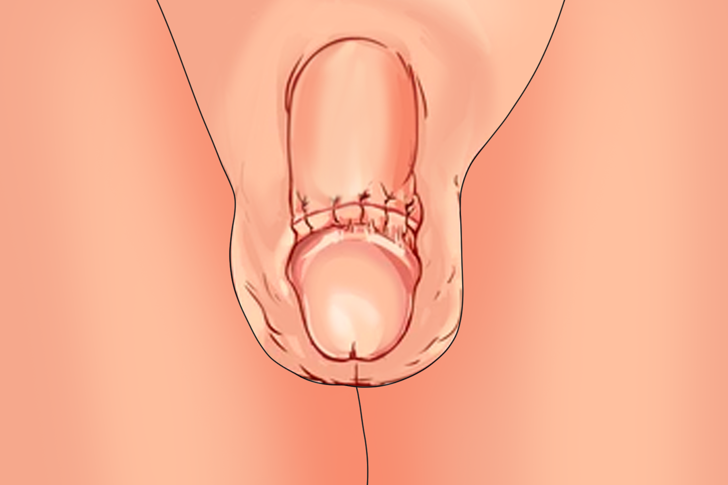 12岁小孩做完包皮术后图