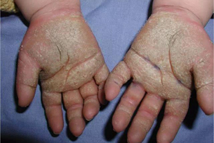 掌跖角化-牙周破坏综合征可造成局部皮肤的局限性过度角化,可有皲裂