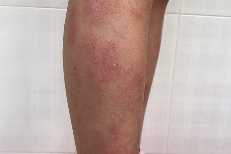 吃海螺过敏变应性皮炎图 吃海螺过敏变应性皮炎图