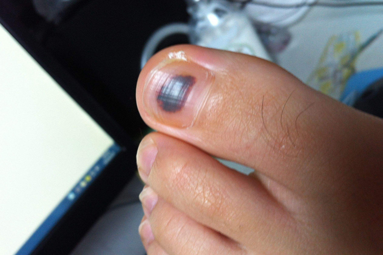 脚趾头甲下出血图