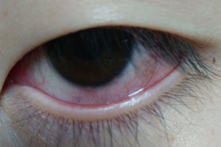 儿童结膜炎白眼球有血丝图 儿童结膜炎白眼球有血丝图