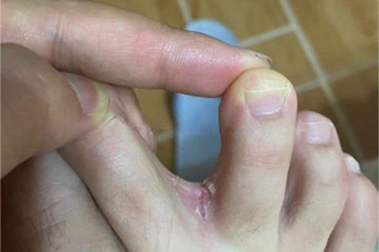 糜烂型足癣脚趾缝糜烂图