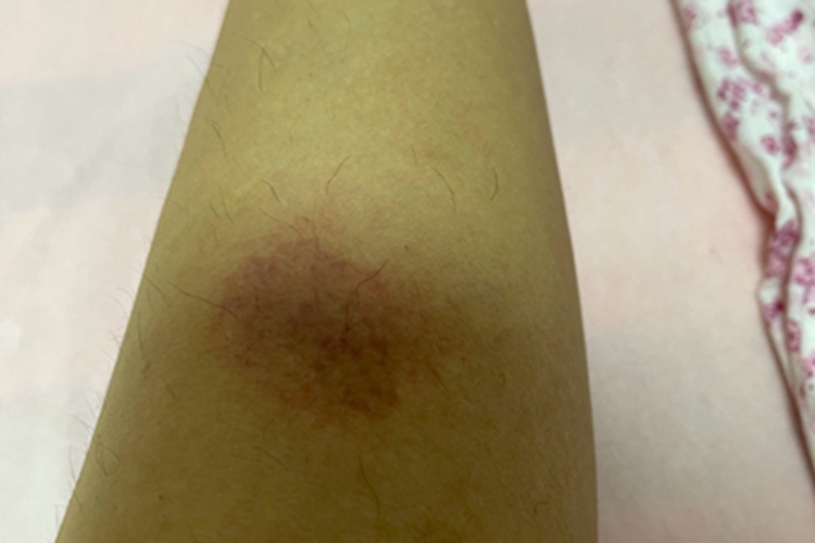 急性湿疹小腿有圆形红斑图