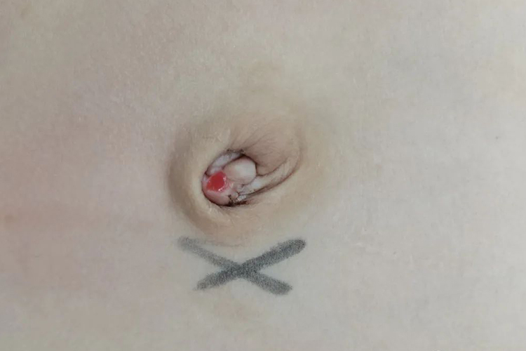 脐肠瘘脐部有红色瘘口图