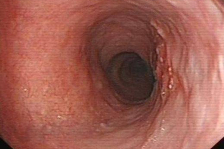 食道鳞状细胞癌图