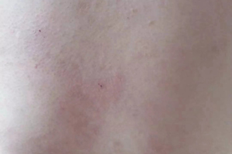 亚急性湿疹背部症状图