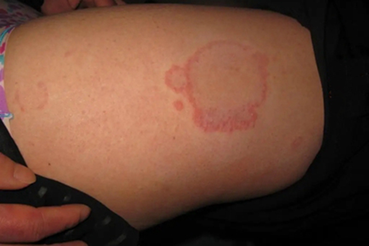 离心性环状红斑大腿症状图