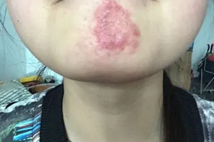 面癣下巴红斑图
