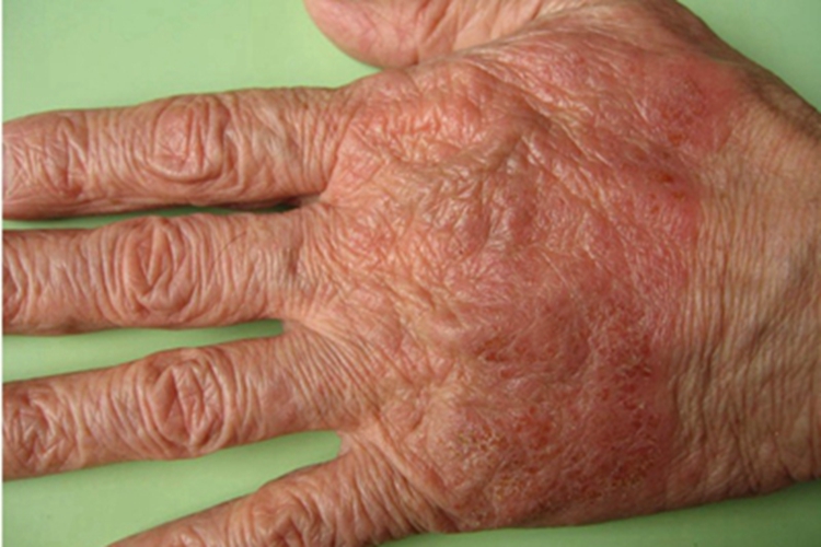急性接触性皮炎手背红斑图 急性接触性皮炎手背红斑图