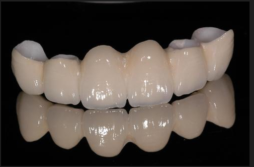 门牙4颗连冠全瓷牙图 门牙4颗连冠全瓷牙图