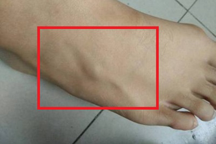 血管外皮细胞瘤脚部症状图