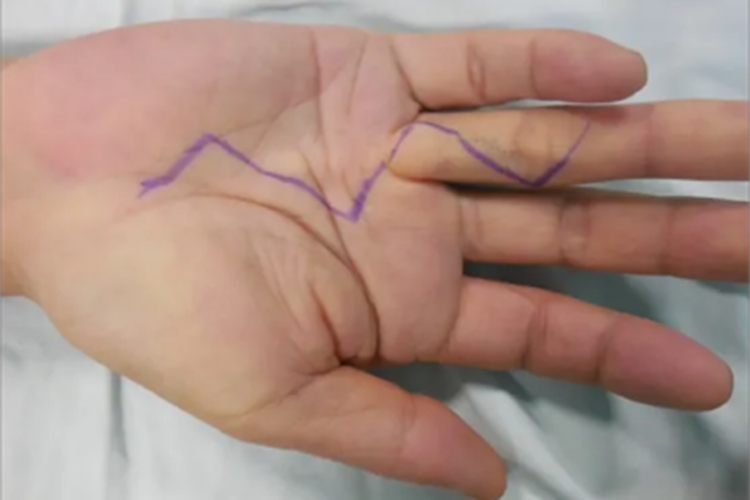 掌腱膜挛缩症手掌结节图 掌腱膜挛缩症手掌结节图