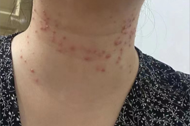 水痘前颈部长了很多红疙瘩图