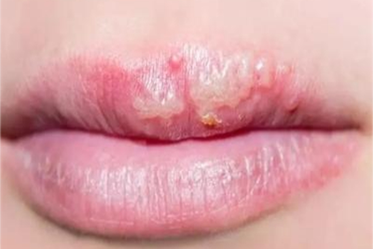 唇疱疹上嘴唇长很多水疱图