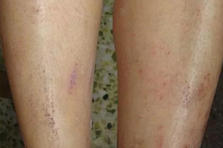 全身性瘙痒症小腿血痂图