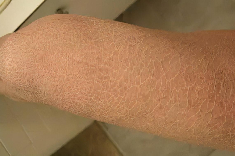 鱼鳞病皮肤干裂起鳞屑图